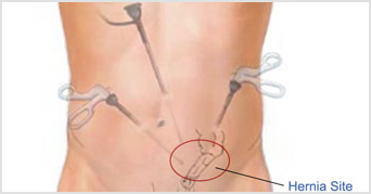Figure 2 From Laparoscopic Transabdominal Pre Peritoneal Tapp