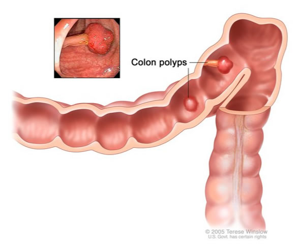 Colonic Polyp