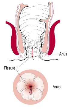 Anal Fissure Diagram