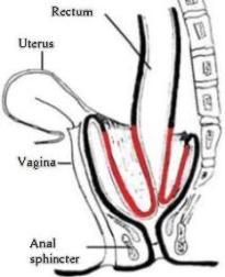 Internal Rectal Prolapse