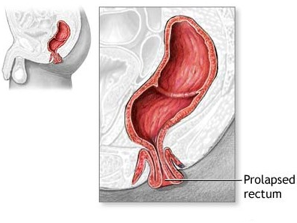 Double Prolapse