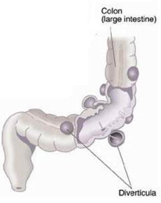 Diverticular Disease