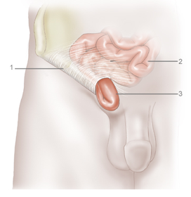 Inguinal Hernia