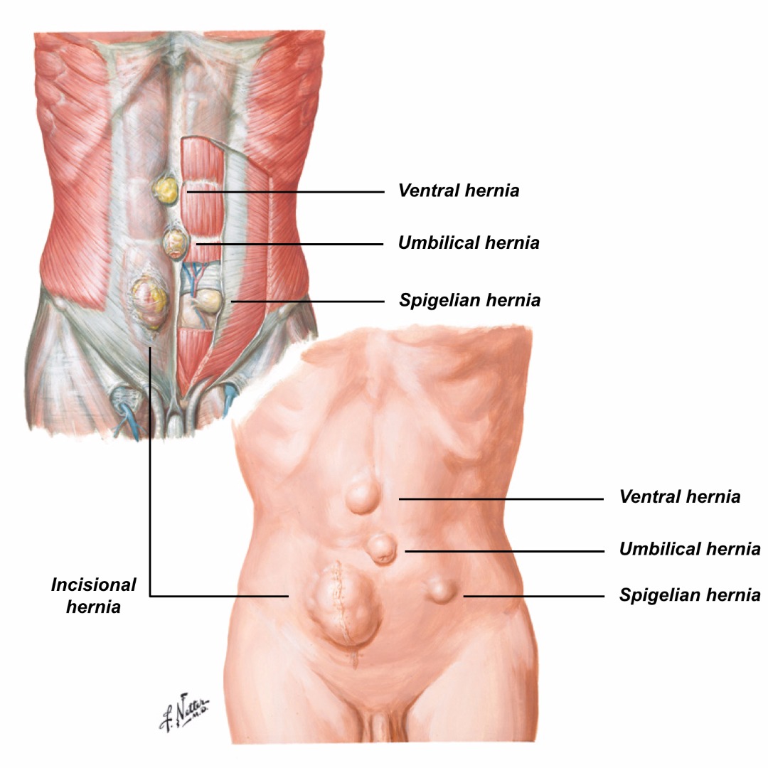 Types of Hernia