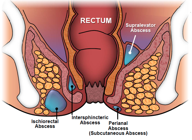 Perianal Abscess