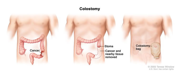Colorectal Cancer Treatment 4 colostomy Illustration