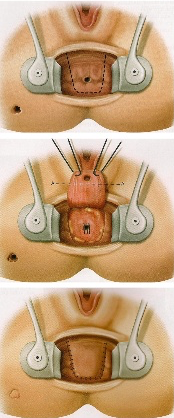 Advancement Flap for Fistula