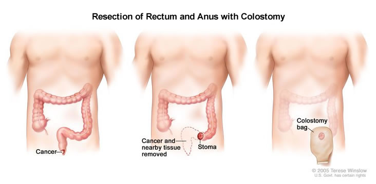 Resection of Colon with Colostomy