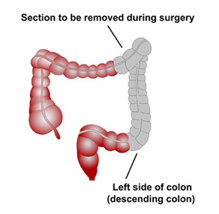 Left Hemicolectomy