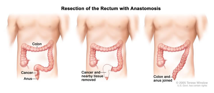 Resection with Anastomosis