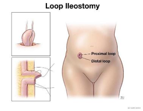 Loop Ileostomy