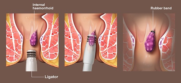 Understanding Thrombosed Hemorrhoids 4 rubber band ligation for thrombosed hemorrhoids treatment illustration