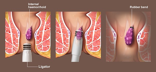 Rubber Band Ligation