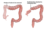 Right Hemicolectomy