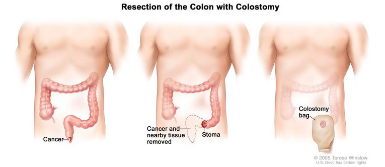 Resection of the Colon with Colostomy