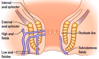 Anal Fistula