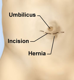 Umbilical Hernia Repair