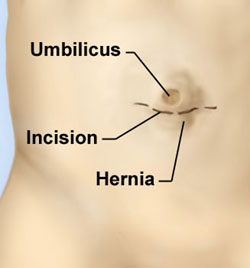 Umbilical Hernia