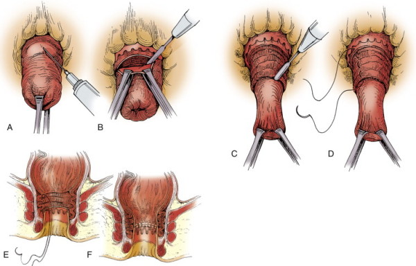 Rectal Prolapse Treatment 3 Perineal Rectosigmoidectomy illustration