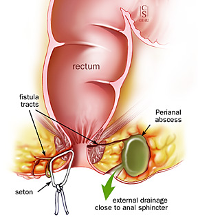 Abscess Surgery Fistula