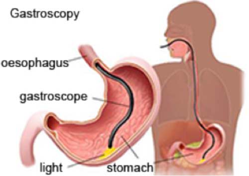 Upper GI Endoscopy