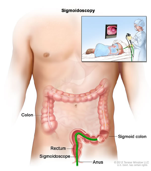 Flexible Sigmoidoscopy